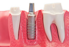 Implants, crowns, bridges, veneers, dentures and implant restorations.